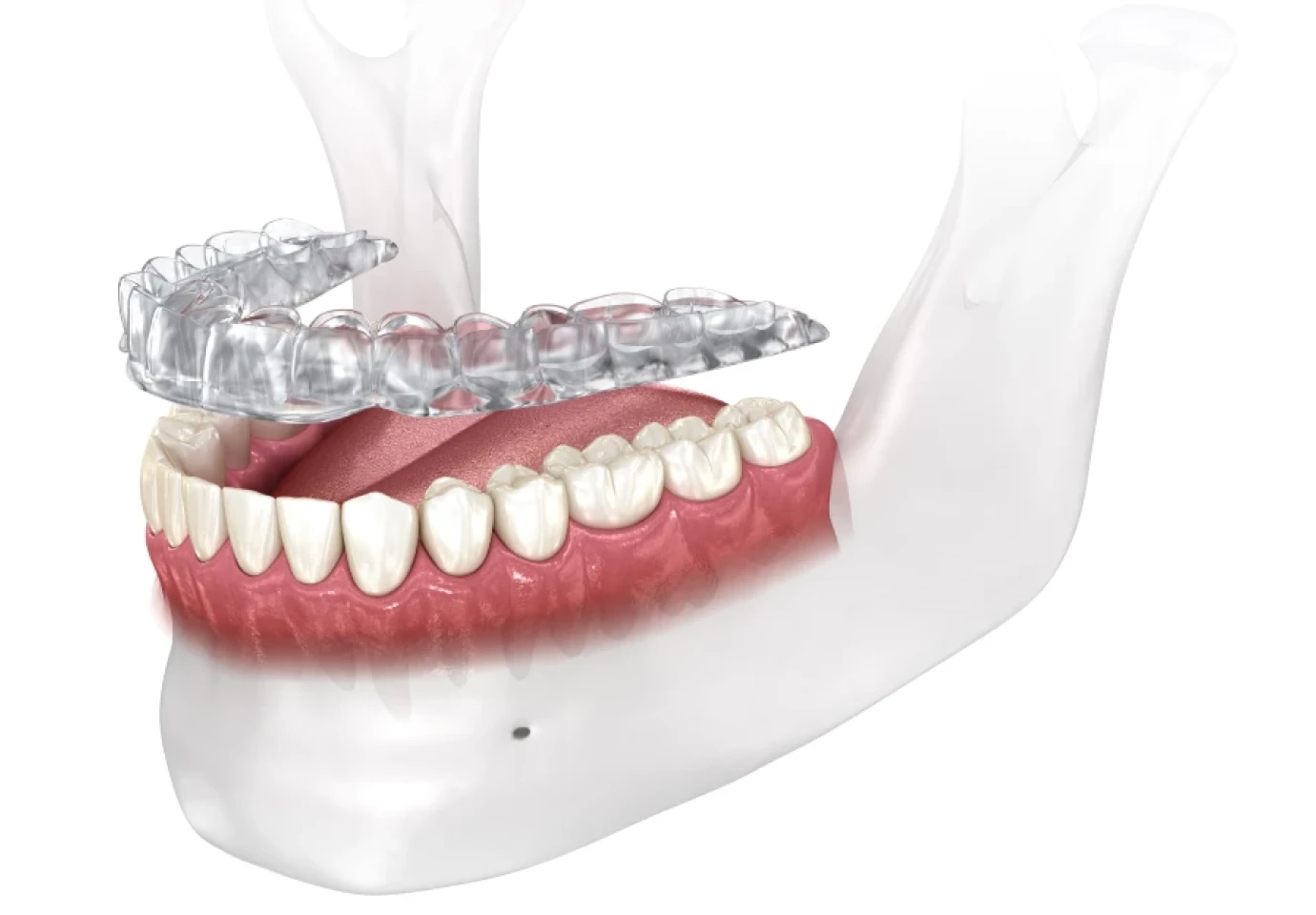gouttiere bruxisme cabinet alti dent eybens Gouttière bruxisme Cabinet dentaire Alti Dent
