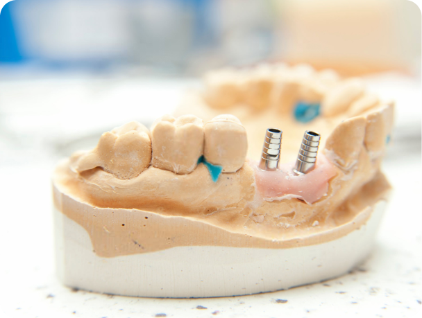 endodontie eybens specialiste Greffe osseuse Cabinet dentaire Alti Dent