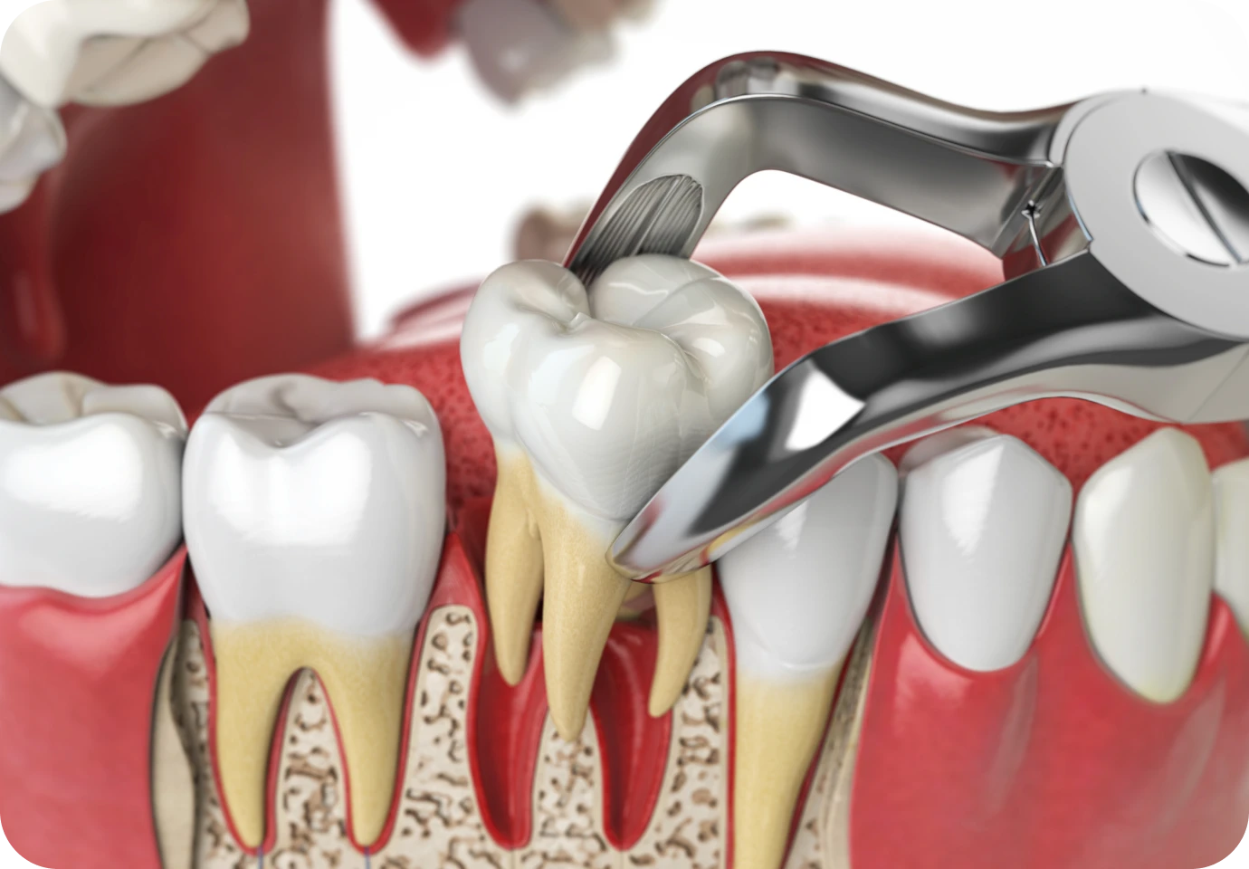 extraction dentaire alti dent Extraction dentaire Cabinet dentaire Alti Dent