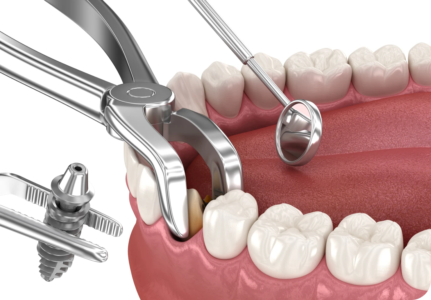 Extraction implantation immediate au cabinet dentaire Alti Dent à Vizille (38220)