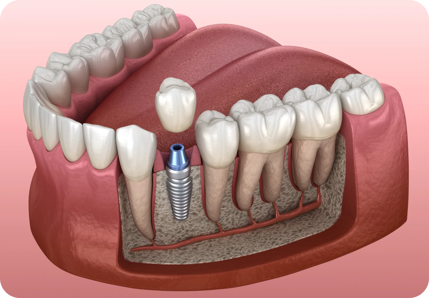 Pose des implants unitaires au cabinet dentaire Alti Dent à Vizille (38220)