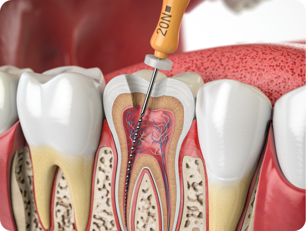 parodontologie chirurgicale eybens technique Endodontie Cabinet dentaire Alti Dent