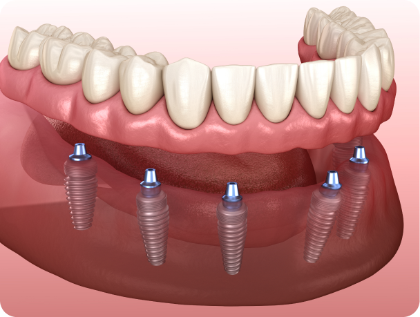 prothese clipsee sur implants Prothèse mobile stabilisée sur implant Cabinet dentaire Alti Dent