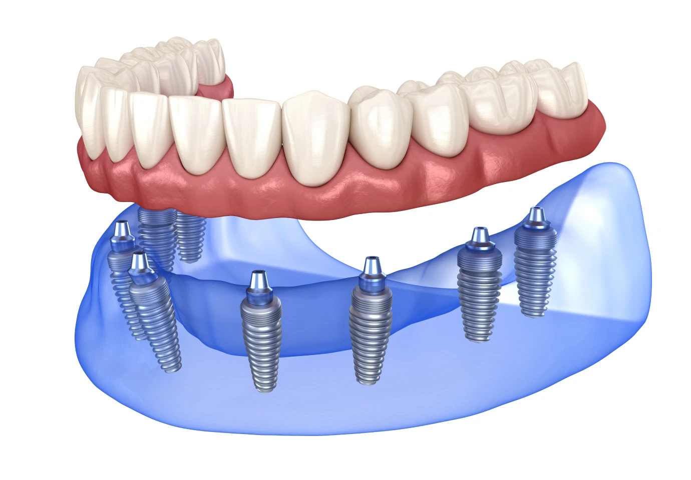 prothese sur implants cabinet alti dent eybens Prothèse mobile stabilisée sur implant Cabinet dentaire Alti Dent
