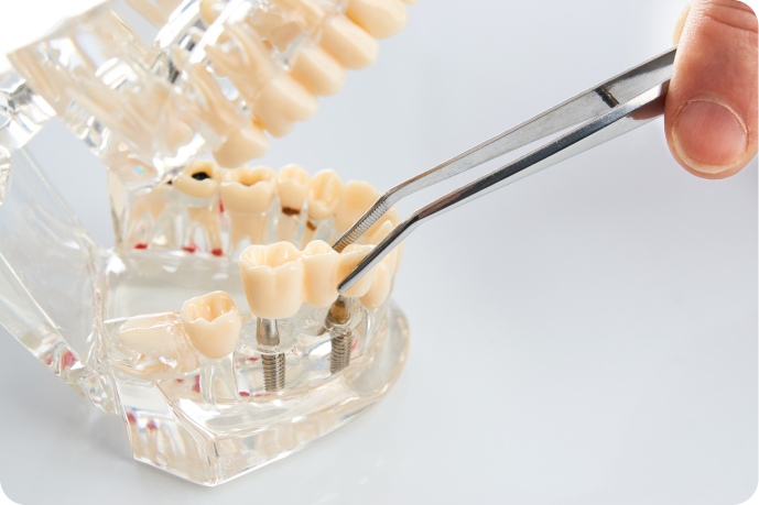 soins conservateurs eybens prevention Prothèse fixe Cabinet dentaire Alti Dent